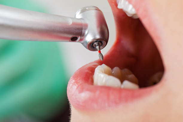 Best Emergency Treatment for Dental Infections or Abscesses in Wildwood, NJ
